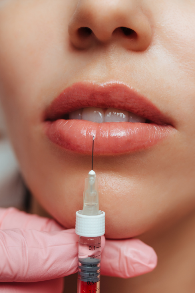 what-to-avoid-before-lip-fillers